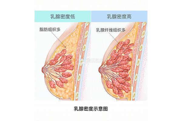 乳腺增生