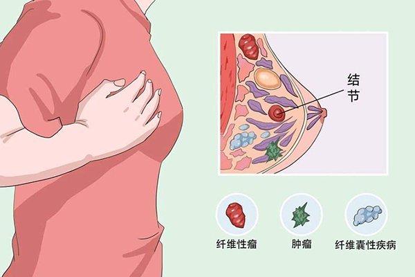 乳腺增生诊断标准