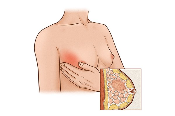 乳腺增生自我诊断