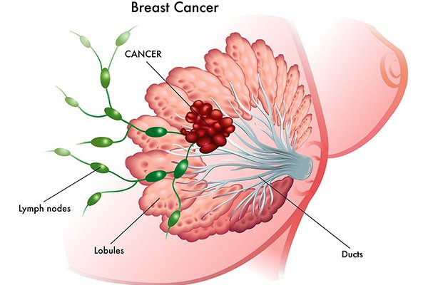 乳腺肿块检查项目