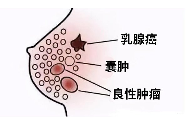 为什么乳腺增生发病率这么高